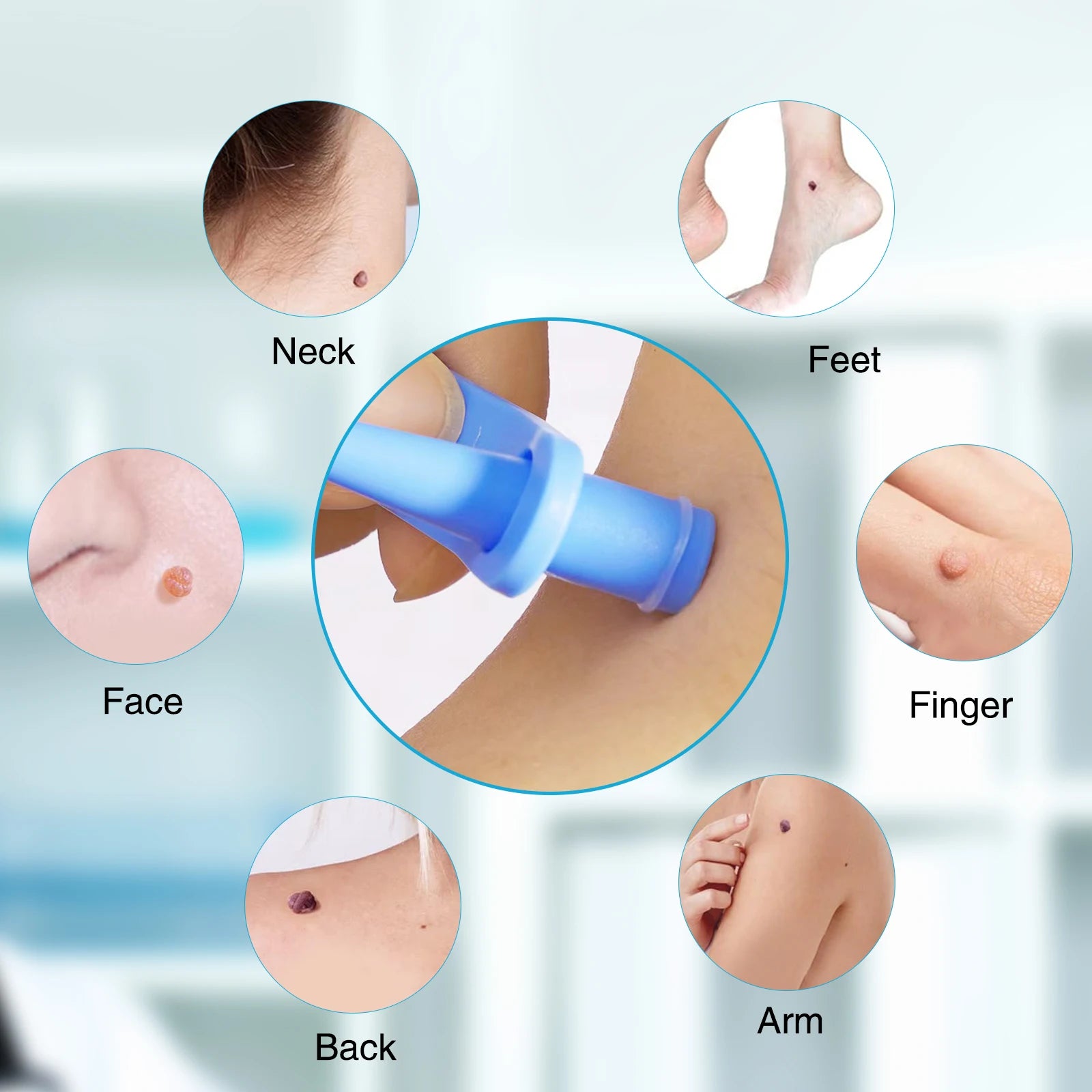 Stylo Anti-Acrochordon™ - Peau parfaite instantanément