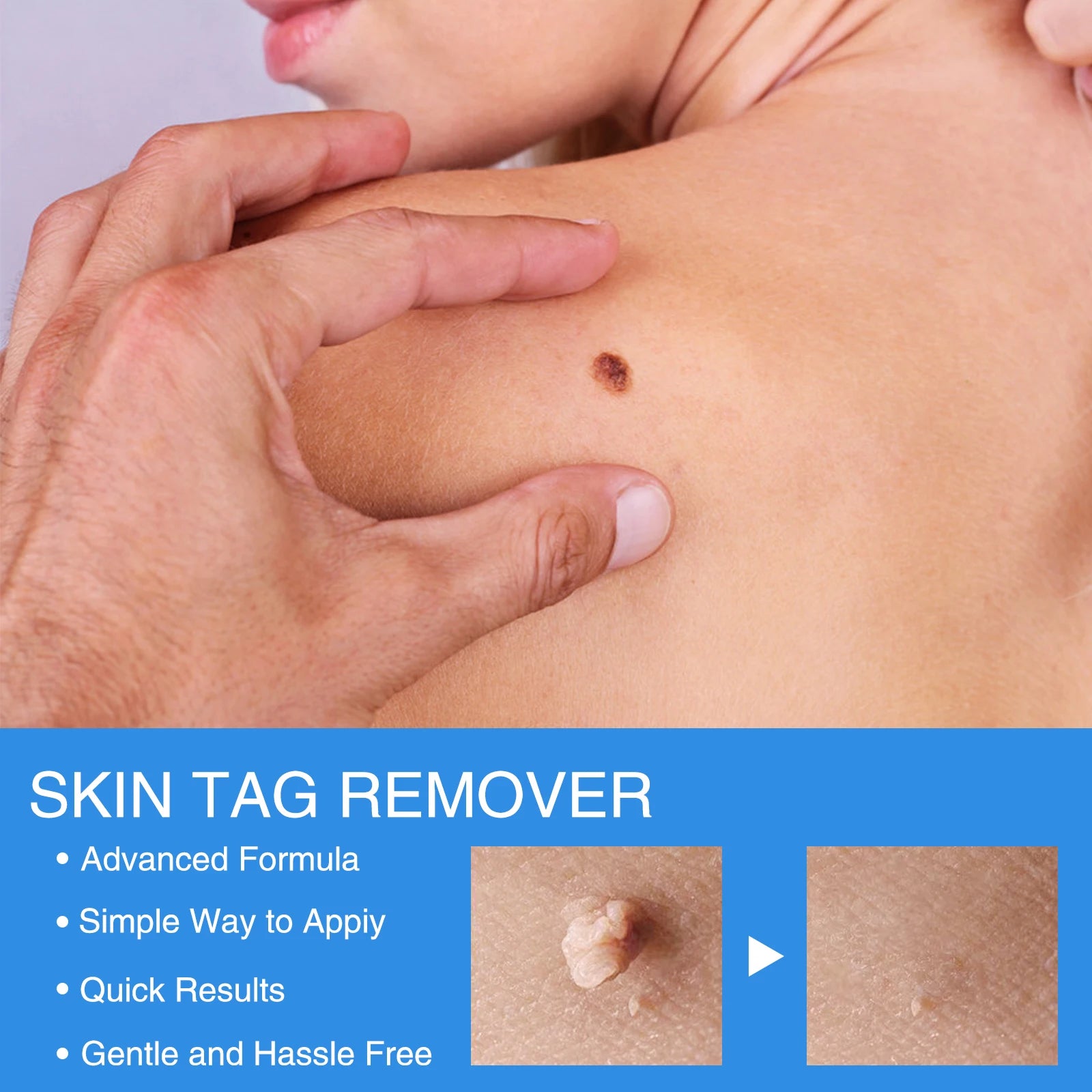 Stylo Anti-Acrochordon™ - Peau parfaite instantanément